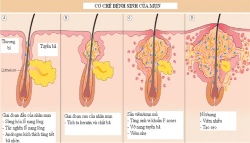Nguyên nhân bị mụn ở người trưởng thành