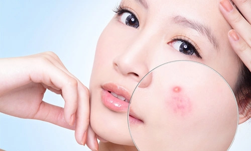 Nguyên nhân bị mụn ở người trưởng thành