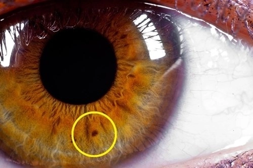 Bạn biết gì về ý nghĩa của chấm đen trên mống mắt 
