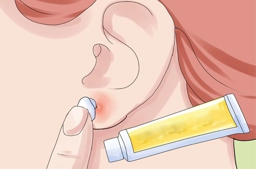 Cách đeo trang sức để không bị ngứa rát nhiễm trùng mưng mủ