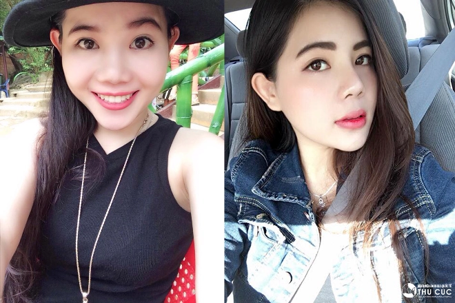 nữ việt kiều mỹ chọn thẩm mỹ mũi tại việt nam