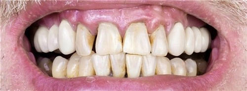 Bệnh về răng miệng nguy hiểm mà bạn cần phải biết