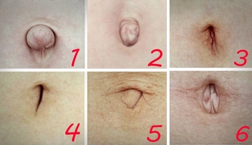 Nhìn hình dạng lỗ rốn biết ngay bạn mắc bệnh gì
