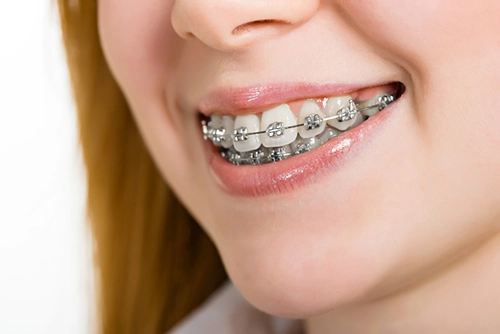 Đôi khi niềng răng không phải cứ đau là sẽ đẹp