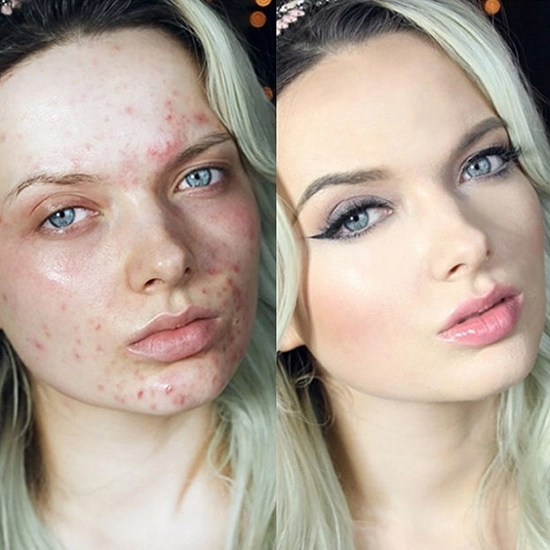 Các siêu nữ này đã chứng tỏ sức mạnh vi diệu của trang điểm che mụn