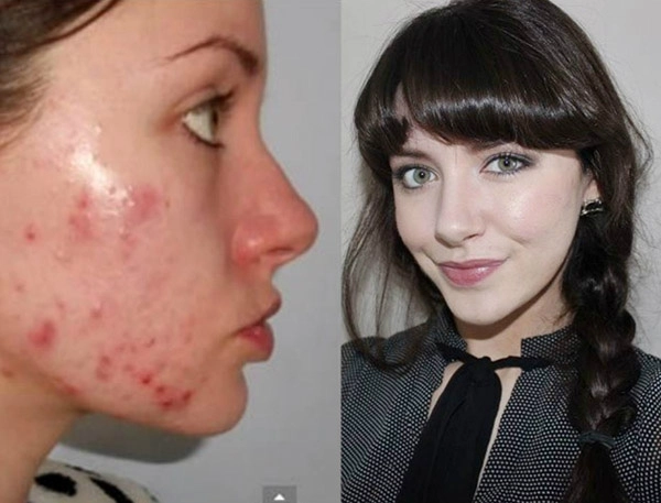 Các siêu nữ này đã chứng tỏ sức mạnh vi diệu của trang điểm che mụn